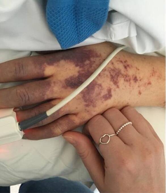 The meningococcal rash on the hand of Sarah Joyce. 