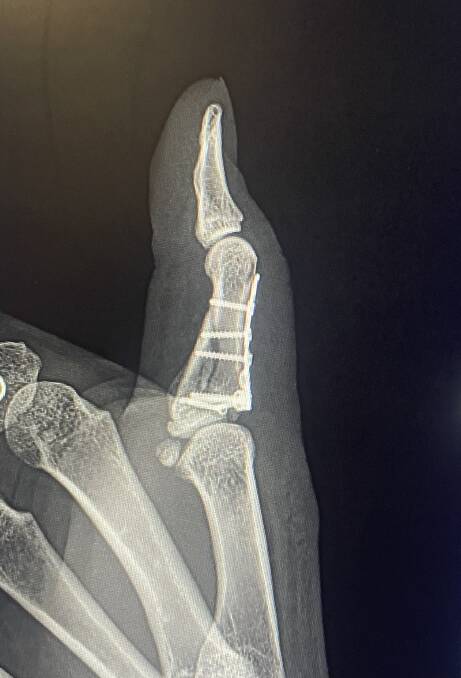 Butler's thumb following surgery. 
