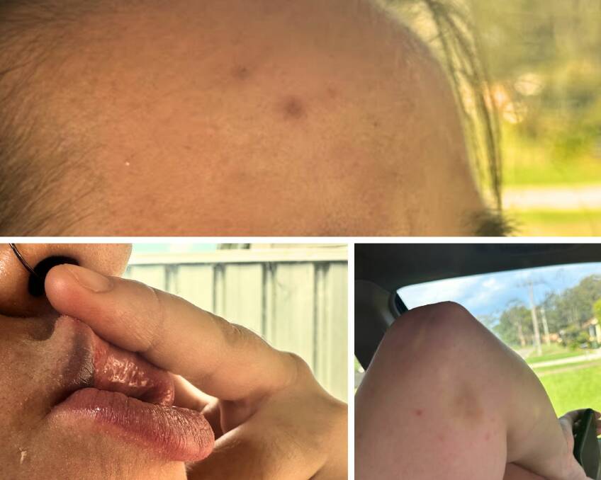 The teenager suffered a black lip after she was allegedly punched in a daytime attack in Kotara. Pictures supplied